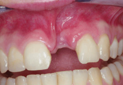 Fractured upper incisor tooth and alveolar bone