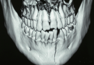X-ray of fractured jaw