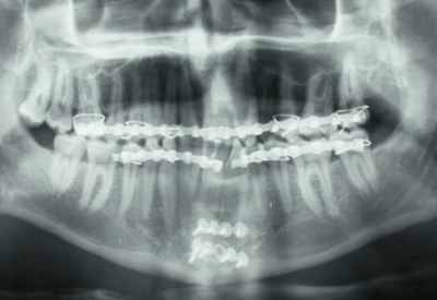 X-ray of facial trauma