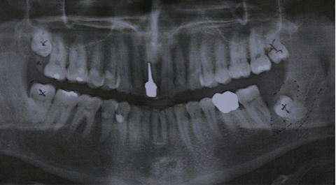X-ray of wisdom teeth
