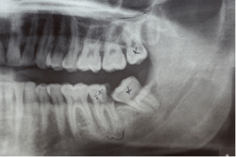 X-ray of wisdom teeth