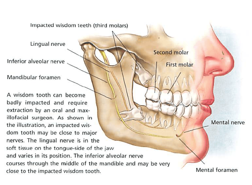 Wisdom tooth diagram